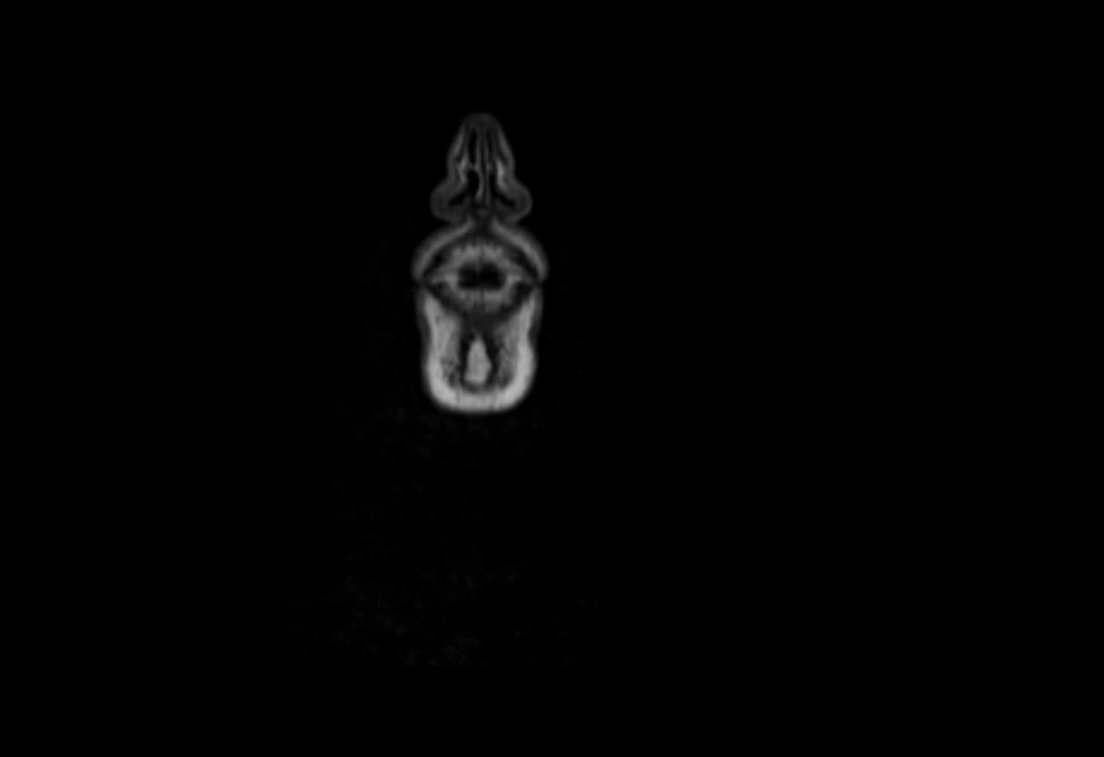 Neck coronal lymph node cross sectional MRI anatomy 3T MRI  image-img-00001-00079.webp